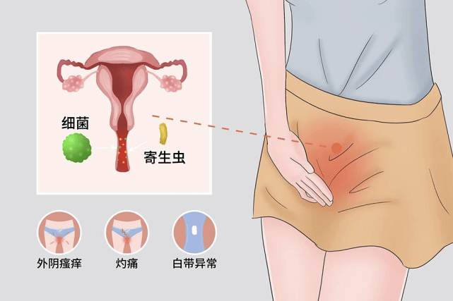 甚至外陰及大腿內側都有明顯的瘙癢不適,白帶呈白色,豆腐渣樣