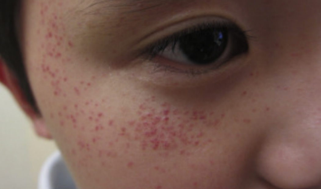 身上长了这4种小红点要抓紧看医生