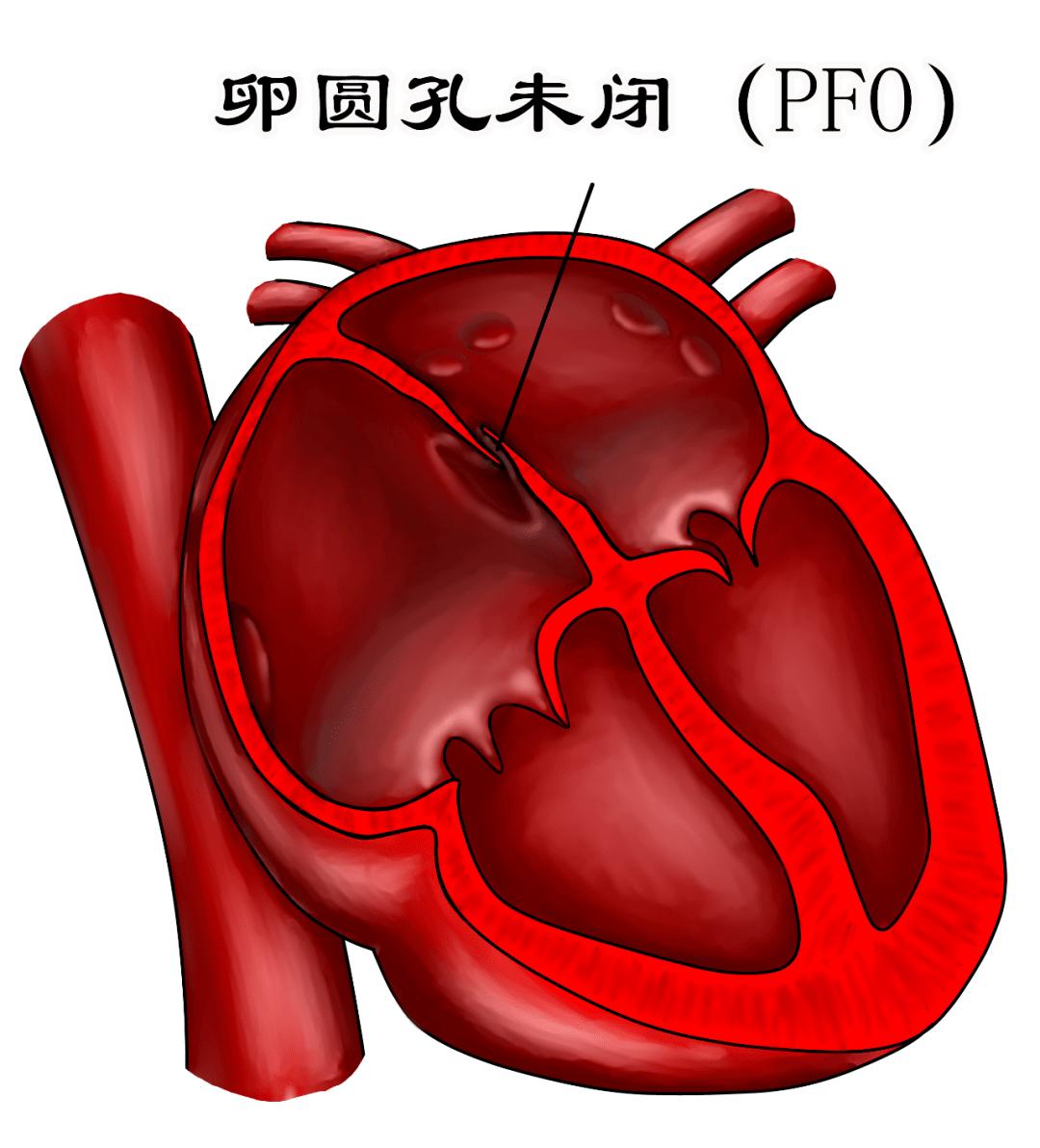 卵圆孔未闭封堵器图片图片