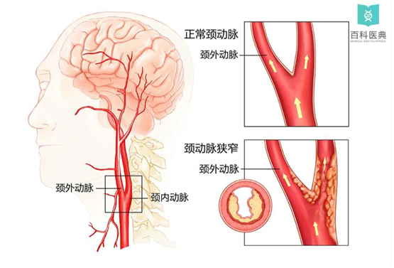 颈动脉鞘神经图片