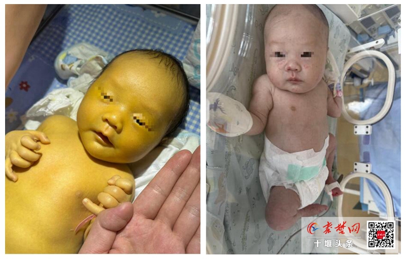 寶寶出生后18天確診“蠶豆病” 十堰人醫(yī)專家為其全身大換血