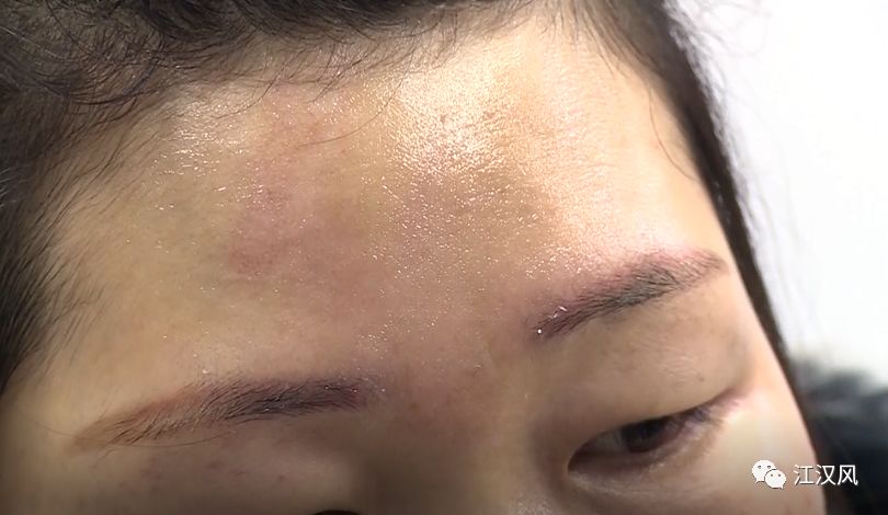 经过医院检查,李女士的额头,左眼周围皮肤被烫伤