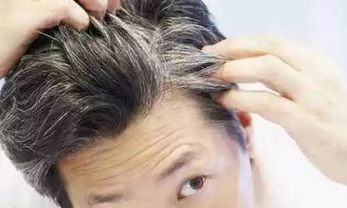 反转了早早长白头发不是未老先衰而是为了对抗痴呆