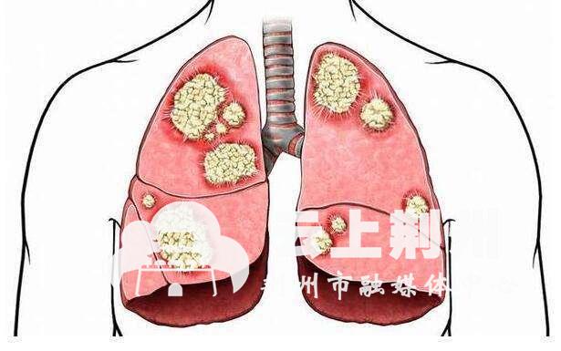 肺癌恶性肿瘤的头号杀手