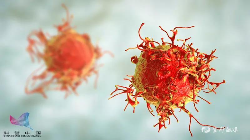 在鳞状细胞癌中,大多数为分化较完全的癌细胞,部分形成角化癌珠.