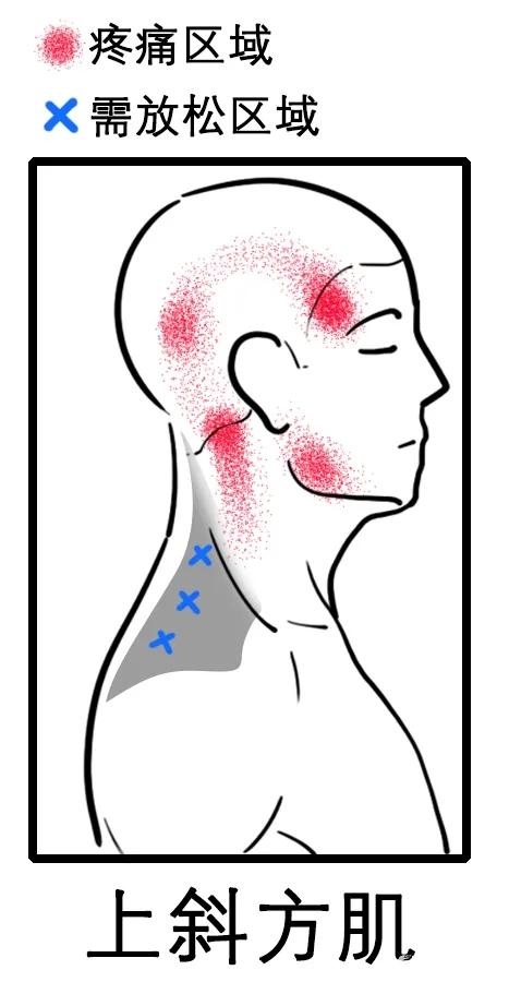 八成頭痛和頸椎有關一份疼痛位置圖解幫你對症放鬆