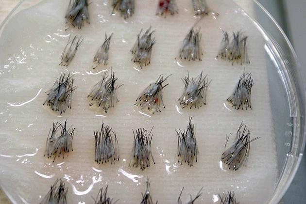 为应对脱发困扰英国推出克隆毛囊技术