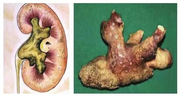 肾脏巨大结石专家凿小孔完美取出