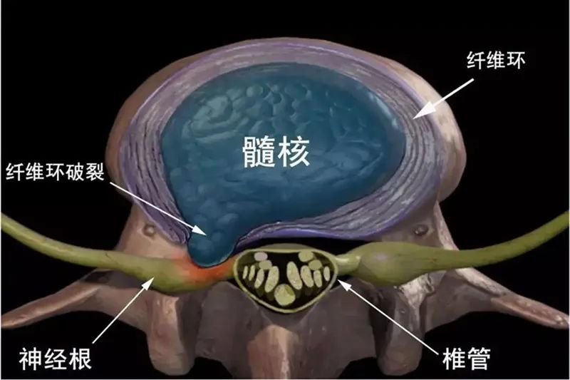 钟祥市中医院射频消融术一针治腰痛