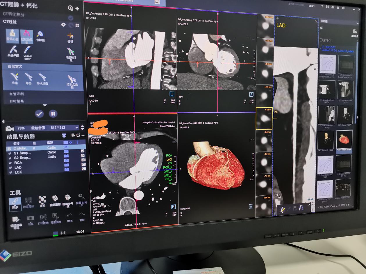 黄石地区首台双源ct落户阳新县人民医院城东院区