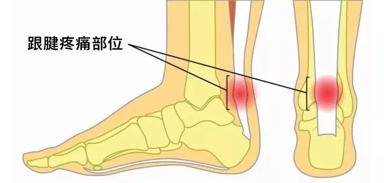 跟腱炎疼痛部位示意图脚踝肌腱炎疼痛部位示意图跑步膝疼痛部位示意图