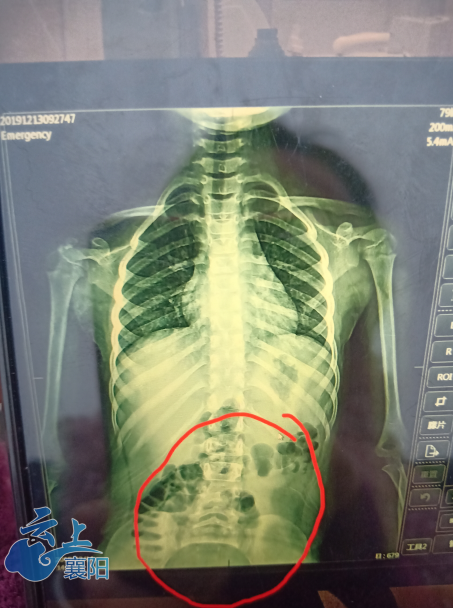五岁半儿童脊柱侧弯家长疑心与学舞有关医生表示