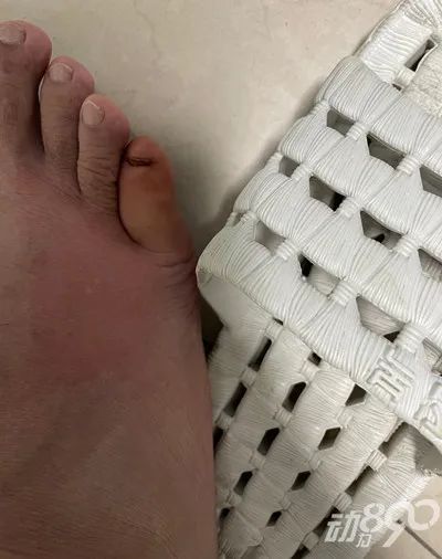 小伙入住襄阳一酒店被蜈蚣咬伤