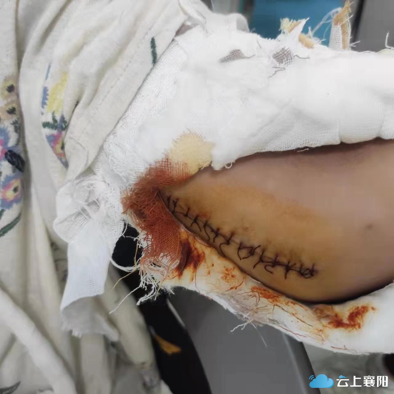 滑滑梯摔伤小朋友能否作证