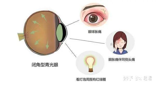 手术电钻怎么用第1健康丨“电钻钻眼”，当心这个视力“强盗”_https://www.jmylbn.com_新闻资讯_第7张