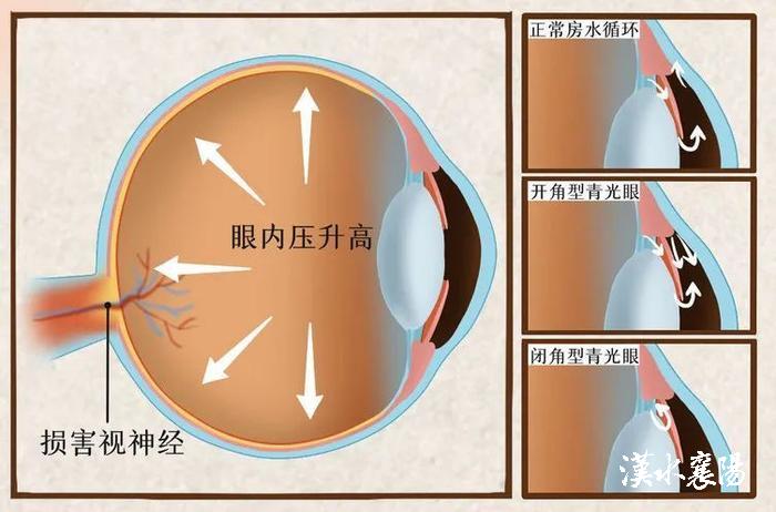 手术电钻怎么用第1健康丨“电钻钻眼”，当心这个视力“强盗”_https://www.jmylbn.com_新闻资讯_第5张