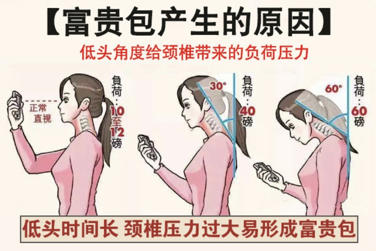 包块(富贵包)患者完成手术,手术顺利,术后患者快速恢复,手术治疗取