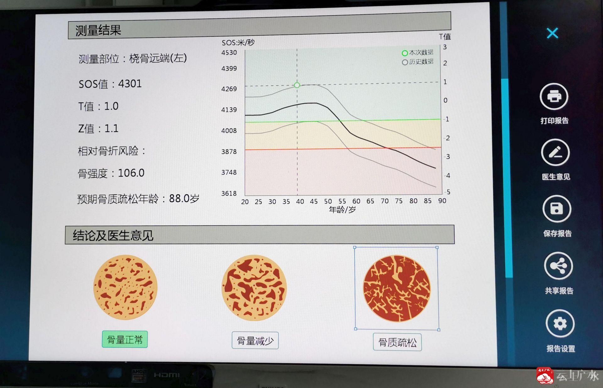 广水一医院骨科引进超声骨密度检测仪