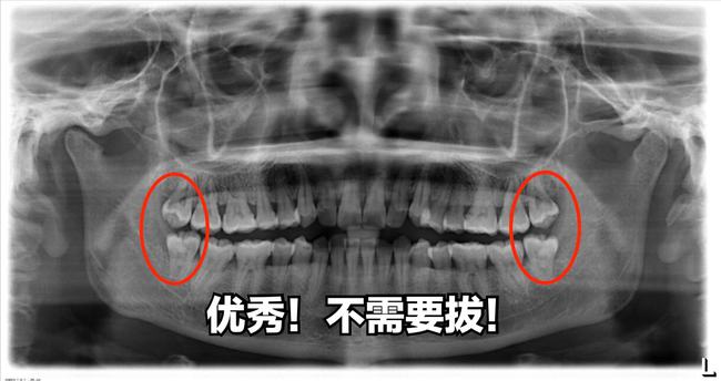 良好;(3)複雜牙儘量上午拔;(4)不能空腹拔牙;(5)拔牙前一定要拍x光片