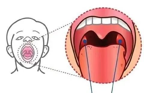 孩子的扁桃體又雙叒叕發炎了說說扁桃體的前世今生