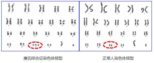 唐氏儿染色体图片