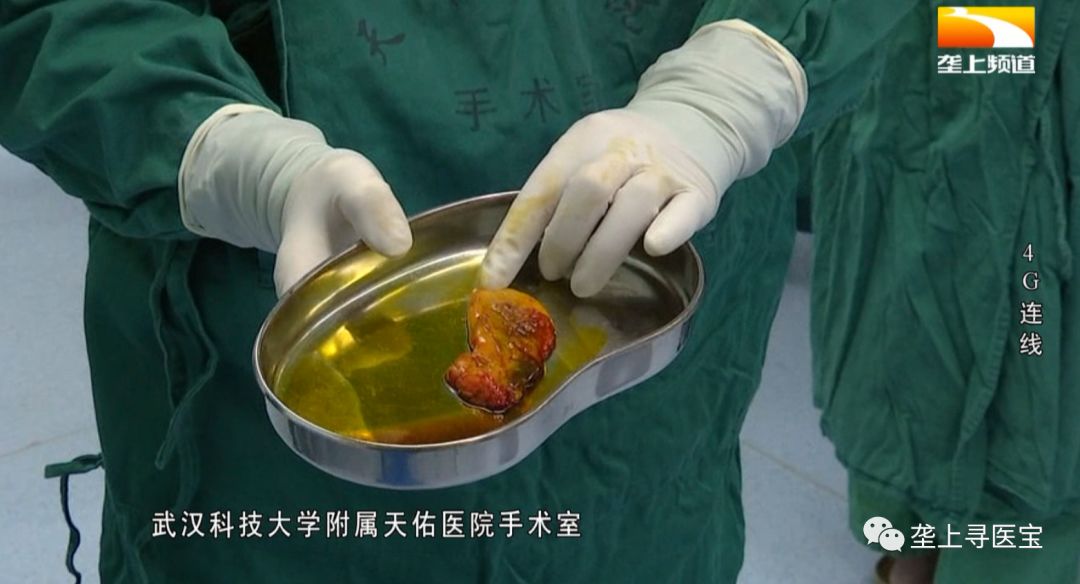 视觉盛宴速来围观现场直播腹腔镜胆囊切除术全过程