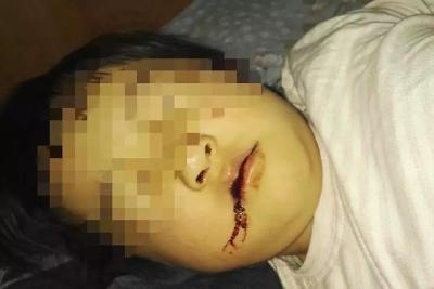 痛心！女童幼儿园内被撞伤！事发半月责任划定仍无说法！