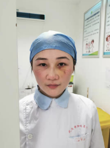 战疫一线群英谱丨 护士累倒鼻骨骨折，延后手术继续战斗