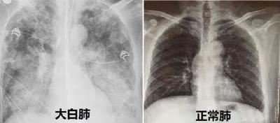 “白肺”提前预警有三招！