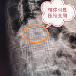 “阳过”之后咳咳咳，90岁老人竟然脊柱骨折......