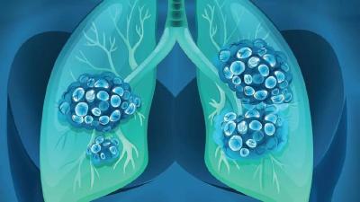 迄今最大最全人肺细胞图谱公布
