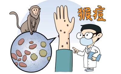 两地接连通报：确诊4例猴痘感染病例，已隔离！