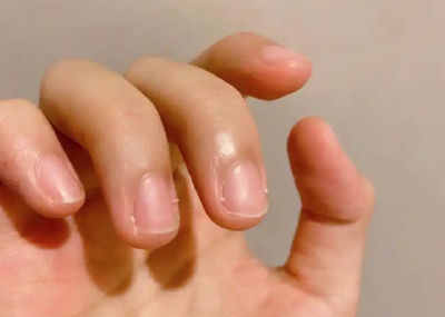 嘴唇发紫、耳垂折痕、指甲月牙变小……真的是疾病信号吗？