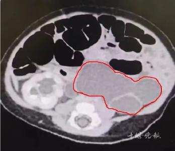 男婴出生就患上这病，严重可致肾切除！十堰医生手术4小时后…