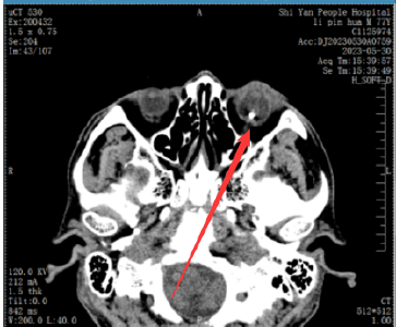 一个险些摘眼球，一个差点失明！十堰医生提醒