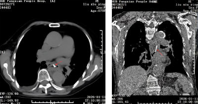 房县人民医院：七旬老人食管穿孔 多学科协作成功“排雷”