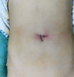 十堰人医：单孔腹腔镜 炫腹无压力
