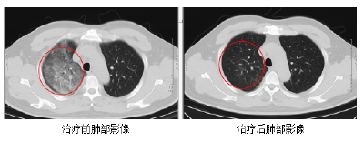 紧急提醒！发现1例！极为罕见 