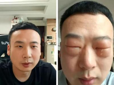 男子吃了8颗，仅10分钟眼睛肿成“奥特曼”！医生提醒