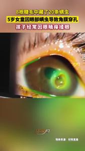 5岁女童角膜穿孔！8根睫毛中竟藏了20条螨虫！