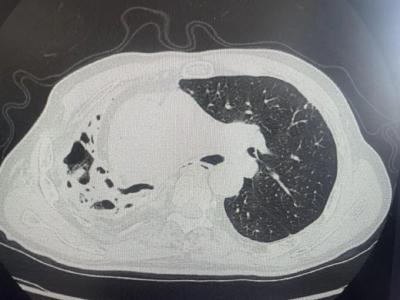 荆州开春“打野”的注意了，已有人中招，右肺严重毁损……