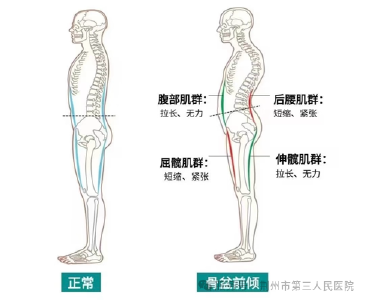 你以为是翘臀？其实是骨盆前倾！