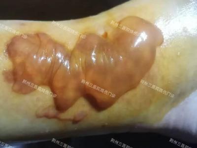 慢性难愈创面，荆州三医精准治愈