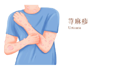 身上一热就起痒疙瘩，怎么办？ 