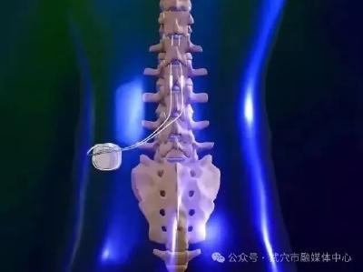 国内首创，武穴籍教授贾一帆团队再次创造医学奇迹 