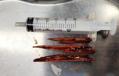 7岁男童遭“竹竿”穿胸，多学科紧急施救化险为夷！