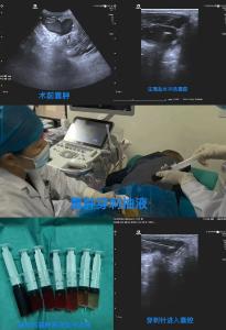 【健康英山】县医共体总医院：超声引导下微创治疗助力八旬老翁告别陈年顽疾