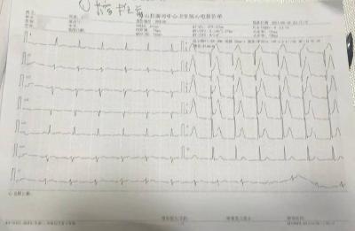 【健康英山】县医共体总医院南河镇分院成功救治一超急性期心肌梗死患者