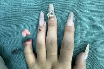 【健康英山】19岁少女断指遗落6小时 医护通宵鏖战成功复活