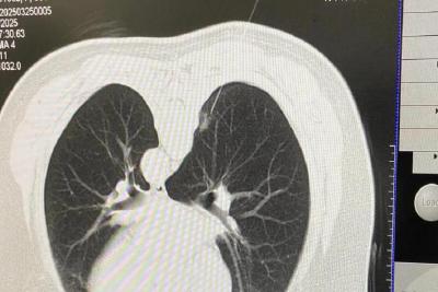 【健康英山】县医共体总医院成功实施首例肺结节术前穿刺联合染色剂定位技术